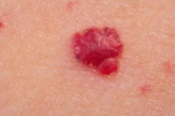 Removal Options For A Cherry Angioma