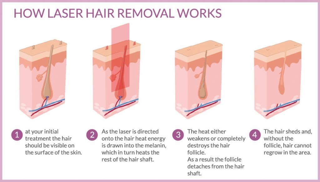 Laser Hair Removal and how does it work?